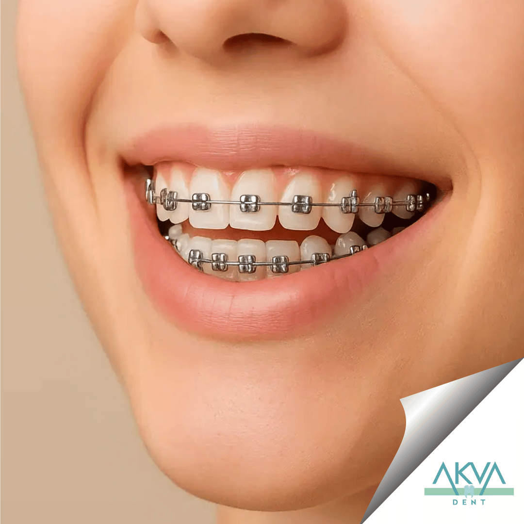 Orthodontic Treatment AkvaDent orthodontic-treatment-akvadent